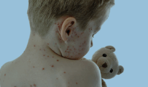 Young child with measles holding teddy bear faces away from camera